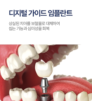 디지털 가이드 임플란트