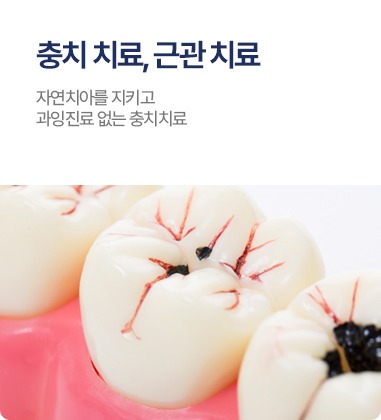 충치 치료, 근관치료
